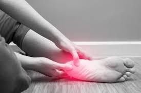 Plantar Fasciitis Plantar Fasciitis